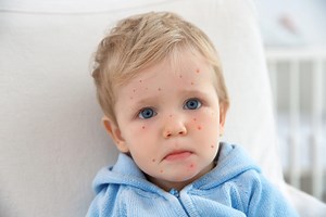 Varicelle : contagion, adulte, comment se transmet-elle ?