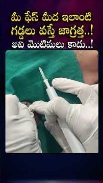 This is the difference between cyst & boil..! You should know this for your skin safety.! How to ...