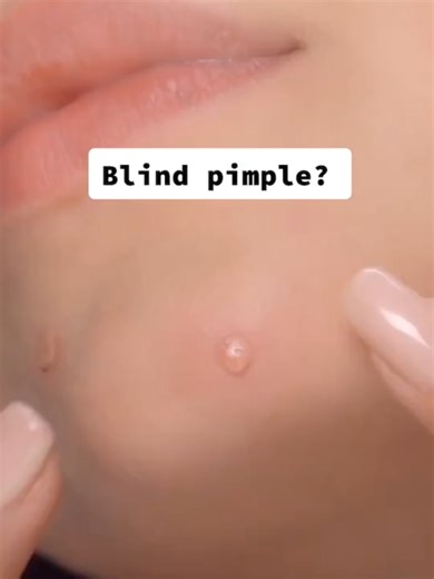 Only here for the pimple hacks!!! 🙌 #hereforonething #beautyhacks #pimple #pimpleremove