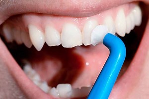What is Oral Prophylaxis or Dental Scaling? - Royal Dental Clinics Blog
