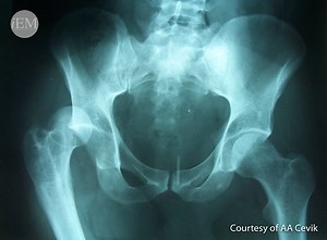 Lower Extremity Injuries