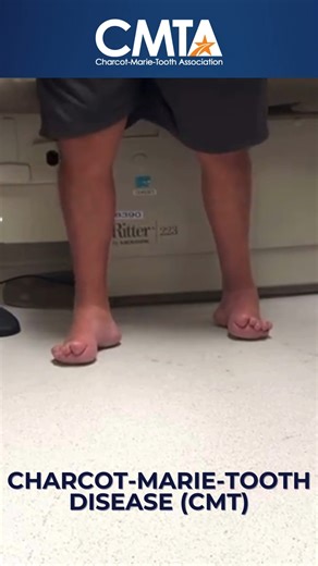 57K views · 623 reactions | PLEASE SHARE Charcot-Marie-Tooth disease...