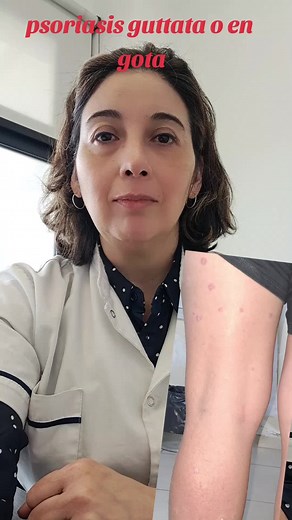 Psoriasis Guttata en Pediatria: Tipos, Síntomas y Tratamiento