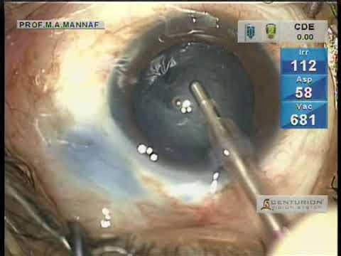 Cataract Eye Surgery @ Harun Eye Foundation Hospital