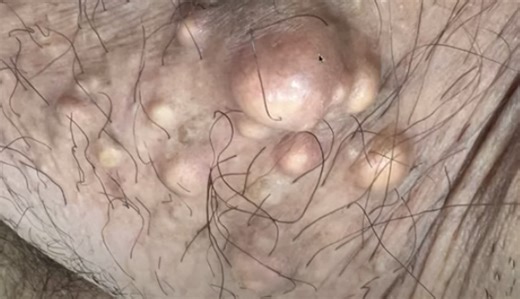 Giant Sebaceous Cysts Removal