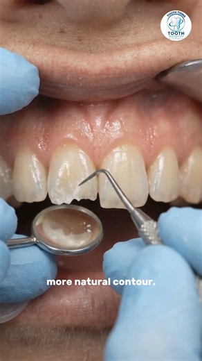 Rough Tooth Edge Smoothing (3D Animation) #toothrestoration #teethtransformation #aianimation