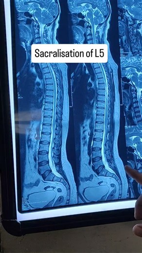 Dr.Mallesh Reddy on Instagram: "🦴 Sacralisation of L5 — a congenital lumbosacral transitional vertebra where the fifth lumbar vertebra partially or completely fuses with the sacrum. Often incidental, but may alter lumbosacral biomechanics and contribute to low back pain in some patients. . . . #SacralisationOfL5 #CongenitalSpine #LumbosacralTransitionalVertebra #LowBackPain #SpineImaging"