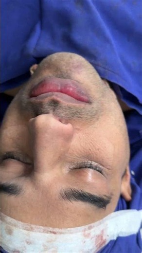 Best Orthognathic and Rhinoplasty maxillofacial and plastic surgery in India