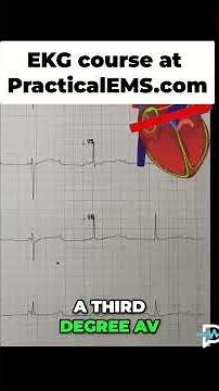 EKG Third Degree AV Block: Heart's Shocking Independence Explained! #shorts