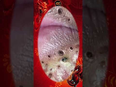 Blackheads Removal | old aged blackheads removal/ cystic blackheads whiteheads removal