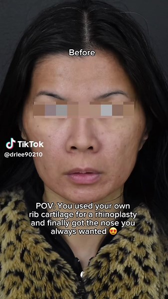 Rebuilding the Nose with Rib Cartilage: A Natural Approach