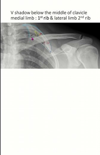 How to identify 1st, 2nd, 3rd rib in chest X ray #xrays #xraymachine #xraytechnologist