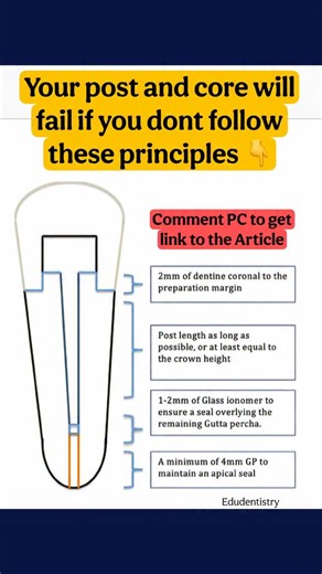 Dr.Vinayak Thorat- Dental Education on Instagram: "What is a Post & Core? It’s a dental procedure where a post (usually metal, fiber, or ceramic) is inserted into the root canal of a tooth, and a core build-up is done over it to provide support for the final crown. Think of it as a foundation + pillar for your dental crown. 🔹 When to Do? ✔️ After Root Canal Treatment (RCT) when too much tooth structure is lost ✔️ When remaining crown structure can’t hold a crown on its own ✔️ In anterior