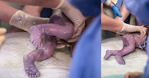 Breech birth captured in incredible photo series - Netmums