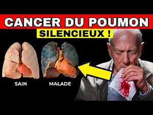 CANCER du POUMON - Premiers SIGNES et SYMPTÔMES, NE LES IGNOREZ PAS !