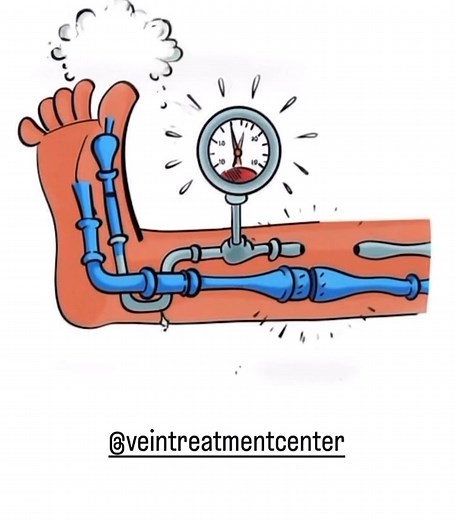 1.2K views | What is venous insufficiency ? Venous insufficiency is...