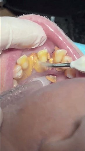 Teeth impossible to save with heavy calculus and tartar #dentist