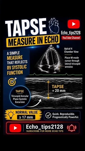 Learn TAPSE measurement in just a few seconds. 📊