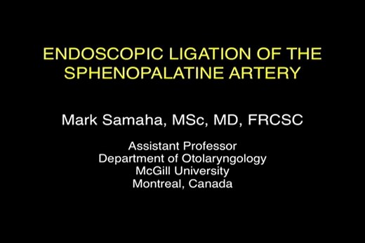 Endoscopic Ligation of the Sphenopalatine Artery