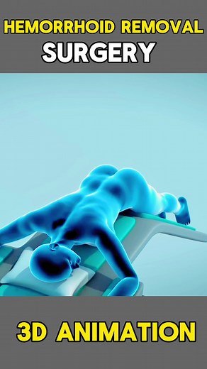 Hemorrhoid Removal Surgery: 3D Animation Procedure Explained