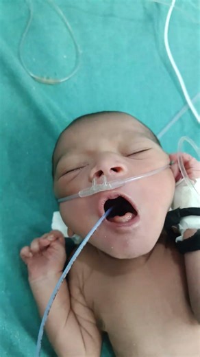 How to Insert an NG Tube for a 3kg Premature Baby. #PrematureBaby #NGTube #NGTubeInsertion