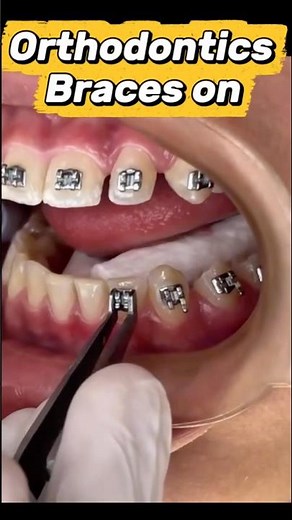 Getting Braces On! 🦷✨ #braces #dentist #teeth