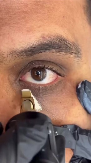#under dark circle #solution#naturaltips #foryoupage #fypage | Dark Circles