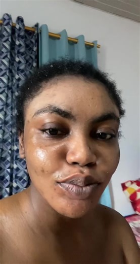 The Struggles After Skin Bleaching - Tips for Healthy Skin Repair