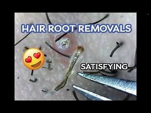 Squishy's #3 Ingrown Hair Root Removals! (Microscopic)
