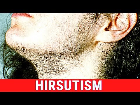 What is Hirsutism? Symptoms, Causes, Treatment