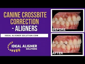 CANINE CROSSBITE CORRECTION - ALIGNERS/IDEAL ALIGNER SOLUTION/CUSTOM ALIGNER TREATMENT PLANING
