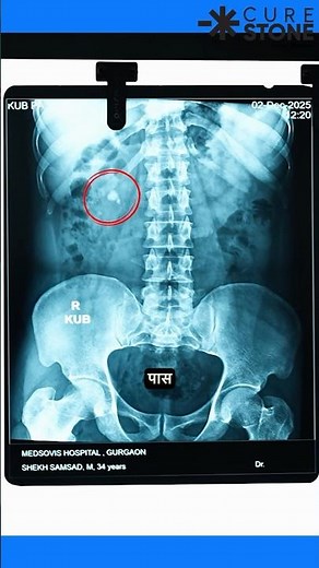 13mm Stone Stuck for 10 YEARS! 😱 RIRS Surgery Animation #Shorts