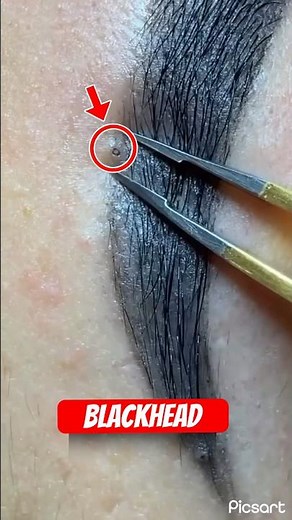 Blackhead in I-Browse: Simple Tool and Aftercare Routine to Prevent Recurrence Quickly#salon