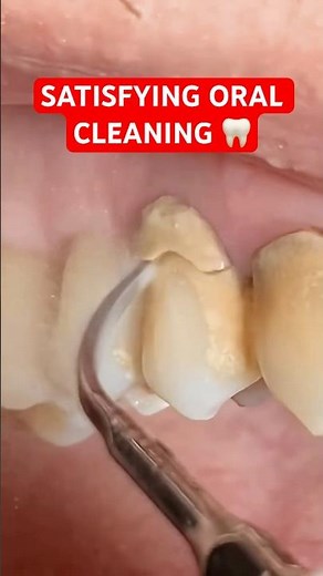 Years of tartar build up removed in one session 🦷