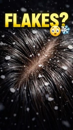Dandruff Snow? 😳❄️ இதை STOP பண்ணுங்க!