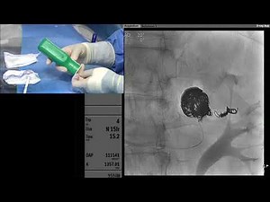 Transradial Coil Embolization of a Renal Artery Aneurysm