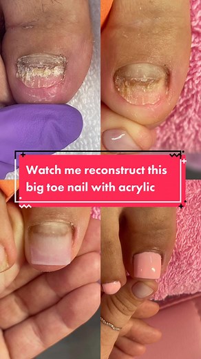 Toe nail fell off? Growing back and feel insecure? No problem, i got you :) #fyp #pedicure #pedi #toetech #bayareanailtech #bayareatoetech #acrylictoes #acrylictoesbayarea #sanjosenails #viral