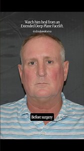 Male Extended Deep Plane Facelift Healing Journey! Watch recovery happen. - Dr. Yula Indeyeva
