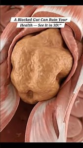 "A Blocked Gut Can Destroy Your Digestion — Watch the Hidden Damage in 3D! | Gut Health"