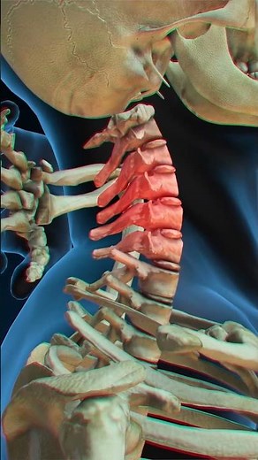 🦴 C1-C2 Fixation: Restoring Stability to the Upper Neck