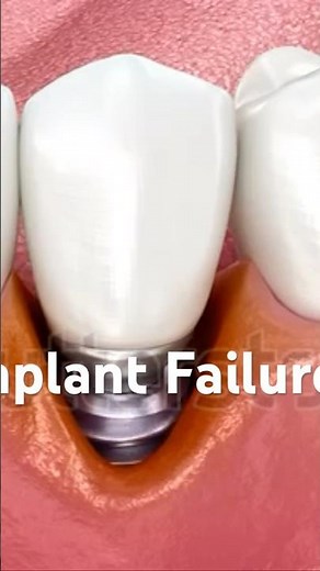 “How to Spot a Failing Dental Implant!”