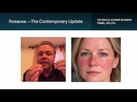 ROSACEA - THE UPDATE | DR RAHUL KUMAR SHARMA MBBS,MD.DVL