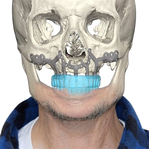 (IPS) Preprosthetic Double Jaw Reconstructive Surgery. Full Arch Maxilla and Mandible Fixed Teeth.