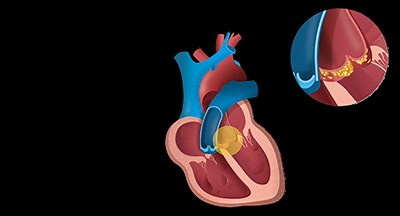 Endocarditis infecciosa | Hospital Clínic Barcelona