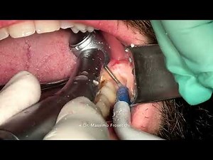 Horizontal wisdom teeth extraction