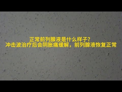 正常前列腺液是怎样？冲击波治疗会阴痛缓解，前列腺液正常What does normal prostate fluid look like?After shock wave treatment