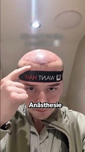 Sein Kopf Ist Nach Der Haartransplantation Angeschwollen