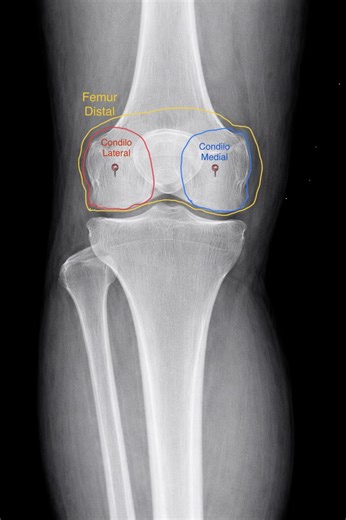 Radiografía de rodilla: Aprende a evaluarla