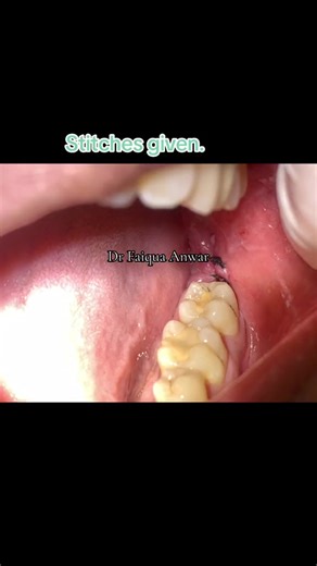 Wisdom tooth out!!! #drfaiquaanwar #calculusslayer #dentist #teeth #extraction