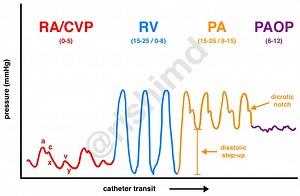 Pulmonary Artery Catheter/Swan-Ganz Structure And Waveforms | RK.MD